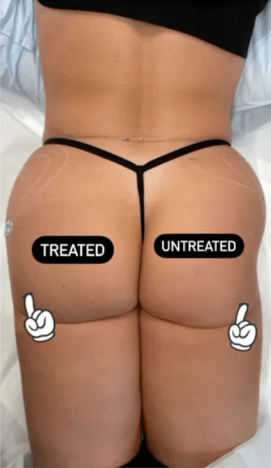 NYC Brazilian Butt Lift - Selfie Plastic Surgery