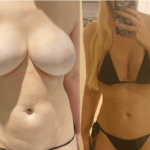 nps_before-after-lipo-360-4.20-min