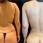 nps_before-after-back-waist-4.12-min