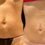 nps_before-after-tummy-tuck