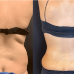 nps_before-after-waist-lipo