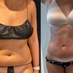 NPS_before-after-abdoment-waist-front-7-10-min
