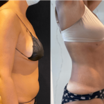 NPS_before-after-abdoment-waist-profile-7-10-min
