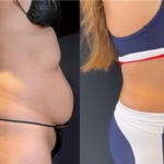 NPS_before-after-coolsculpting-revision-waist-7.29-min