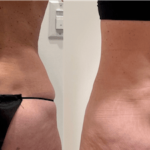NPS_before-after-liposuction-waist-7.29-min