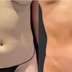 NPS_abdomen-before-after-9.27.21-min
