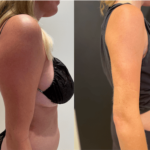 nps_arm-lipo-before-after-9.27.21-min