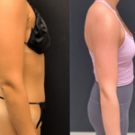 nps_before-after-arm-lipo-.21.21-min