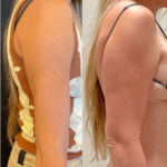 nps_before-after-arm-lipo-2-9.14-min