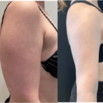nps_before-after-arm-lipo-3-9.14-min