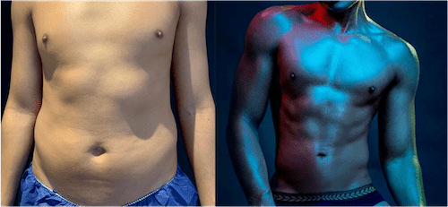 nps_male-lipo-before-after-9.27.21-min