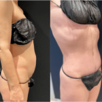 nps_tummy-tuck-before-after-9.27.21-min