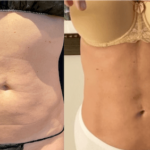 nps_before-after-abdomen-coolsculpting-revision-10.16-min