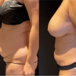 nps_before-after-coolsculpting-revision-10.11.21-min