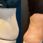 nps_before-after-abdomen-waist-11.17-min