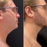 nps_before-after-neck-lipo-min