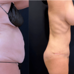 nps_before-after-tummy-tuck-11.17-min
