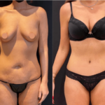 before-after-abdominoplasty-2_12-17-min