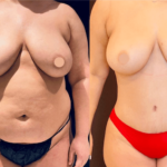 before-after-abdominoplasty-3_12-17-min