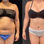 before-after-abdominoplasty_12-17-min