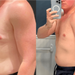 nps_before-after-gynecomasta-12.6