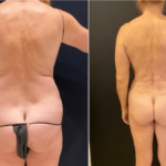 nps_before-after-tummy-tuck-back-12.6