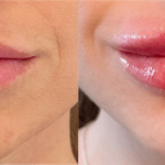 nps_before-after-lip-fillers