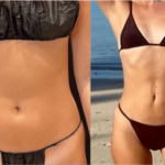 ps_before-after-lipo360