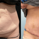 nps_before-after-tummy-tuck