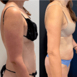 nps_before-after-arm-lipo-2.15