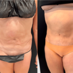 nps_before-after-tummy-tuck-2.22-min