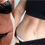 nps_before-after-tummy-tuck-3.2-min