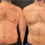 nps_before-after-male-abdomen-3.9-min