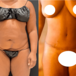nps_before-after-tummy-tuck-2-4.4-min