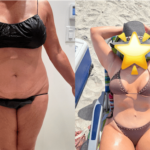 nps_before-after-tummy-tuck-3-4.4-min