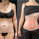 nps_before-after-tummy-tuck-4-4.4-min