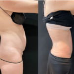 nps_before-after-tummy-tuck-5-4.4-min