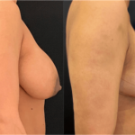 nps_before-after-breast-reduction-2-6.15-min
