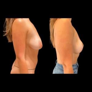 NPS_before-after-breast-hp-1-min