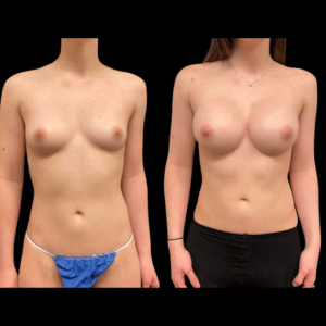 NPS_before-after-breast-hp-2-min