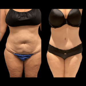 NPS_before-after-lipo-360-hp-min