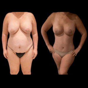 NPS_before-after-tummy-tuck-hp-min