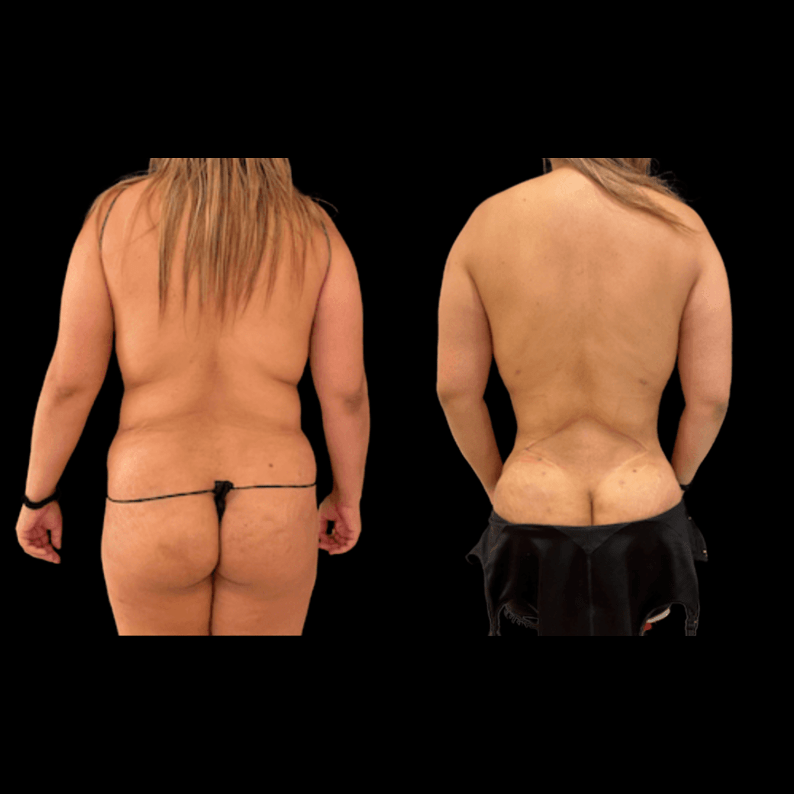 Smartlipo Flanks Liposuction for Women - Before & After Photos