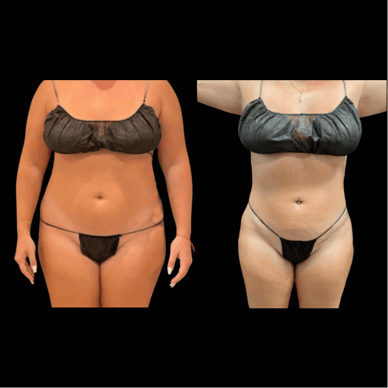 nps_before-after-abdoment-waist-lipo