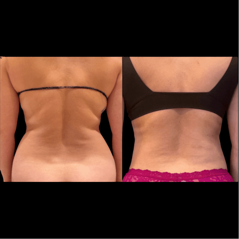 Lipo For Women Before & After NYC