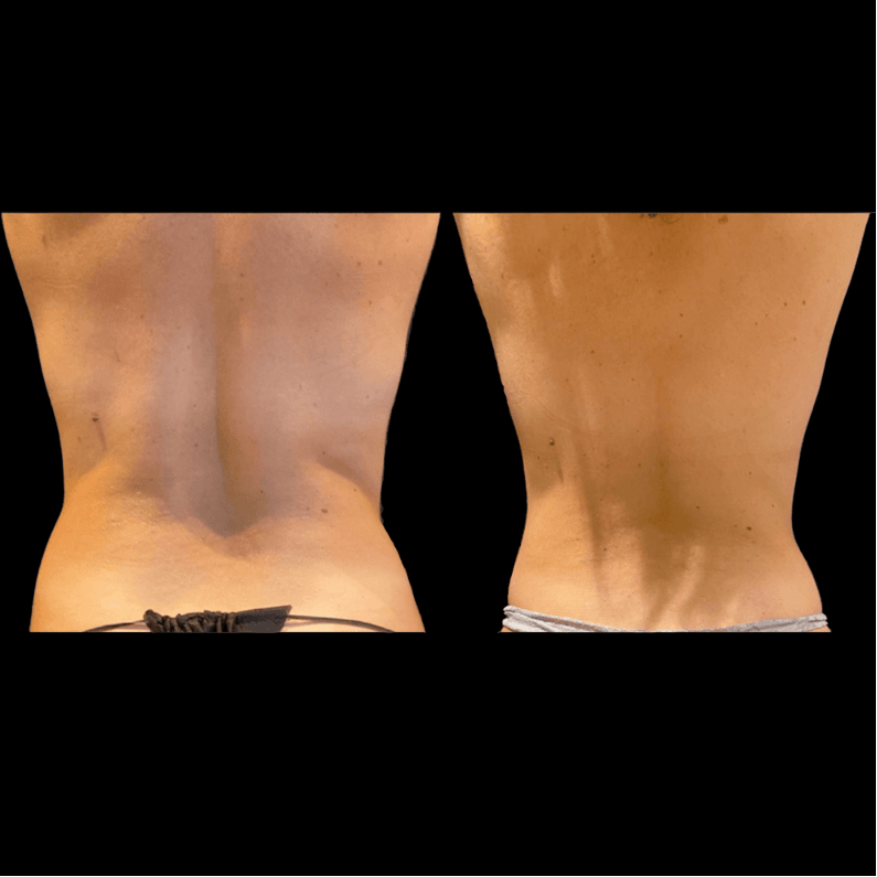 Liposuction Before & After Photos Patient 39, Marietta, GA