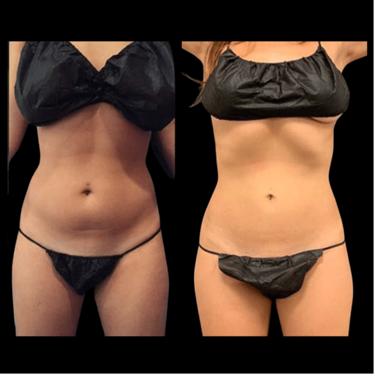 Abs And Waist Liposuction Before And After Neinstein Plastic Surgery