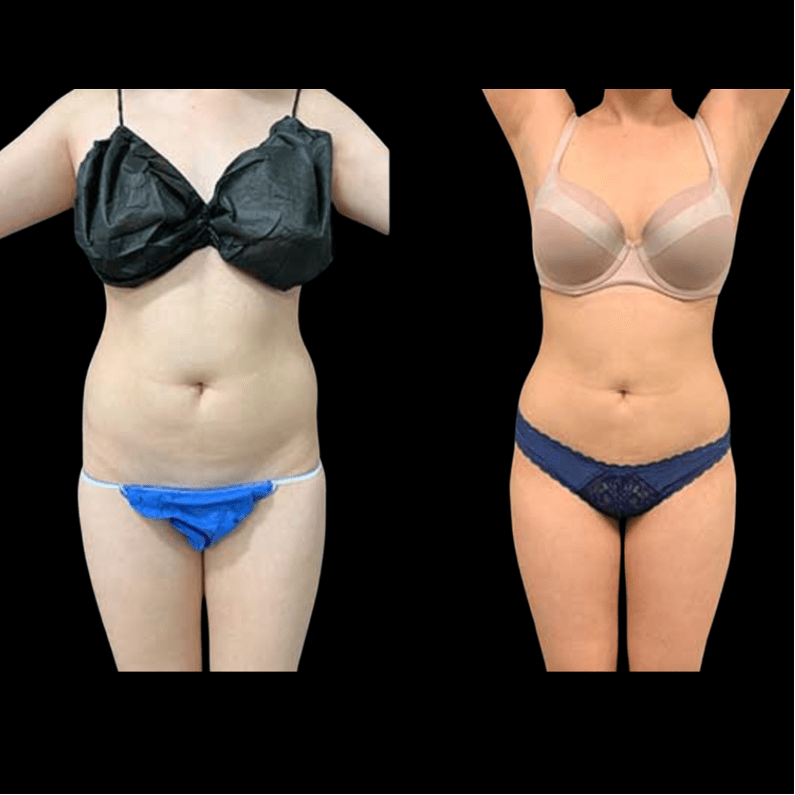 nps_before-after-abdoment-waist-lipo