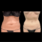 nps_before-after-abdominoplasty-tummy-tuck-1-min