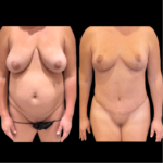 nps_before-after-abdominoplasty-tummy-tuck-1-min